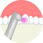歯の表面を仕上げ磨き